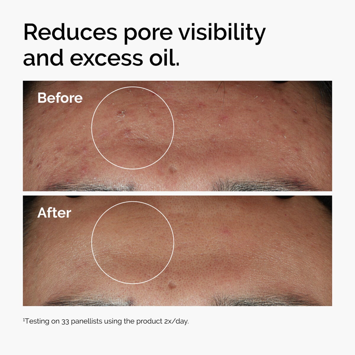niacinamide-10-zinc-1-c4 ord-niacinamide-zinc-blemish-serum-before-after-pores.jpg