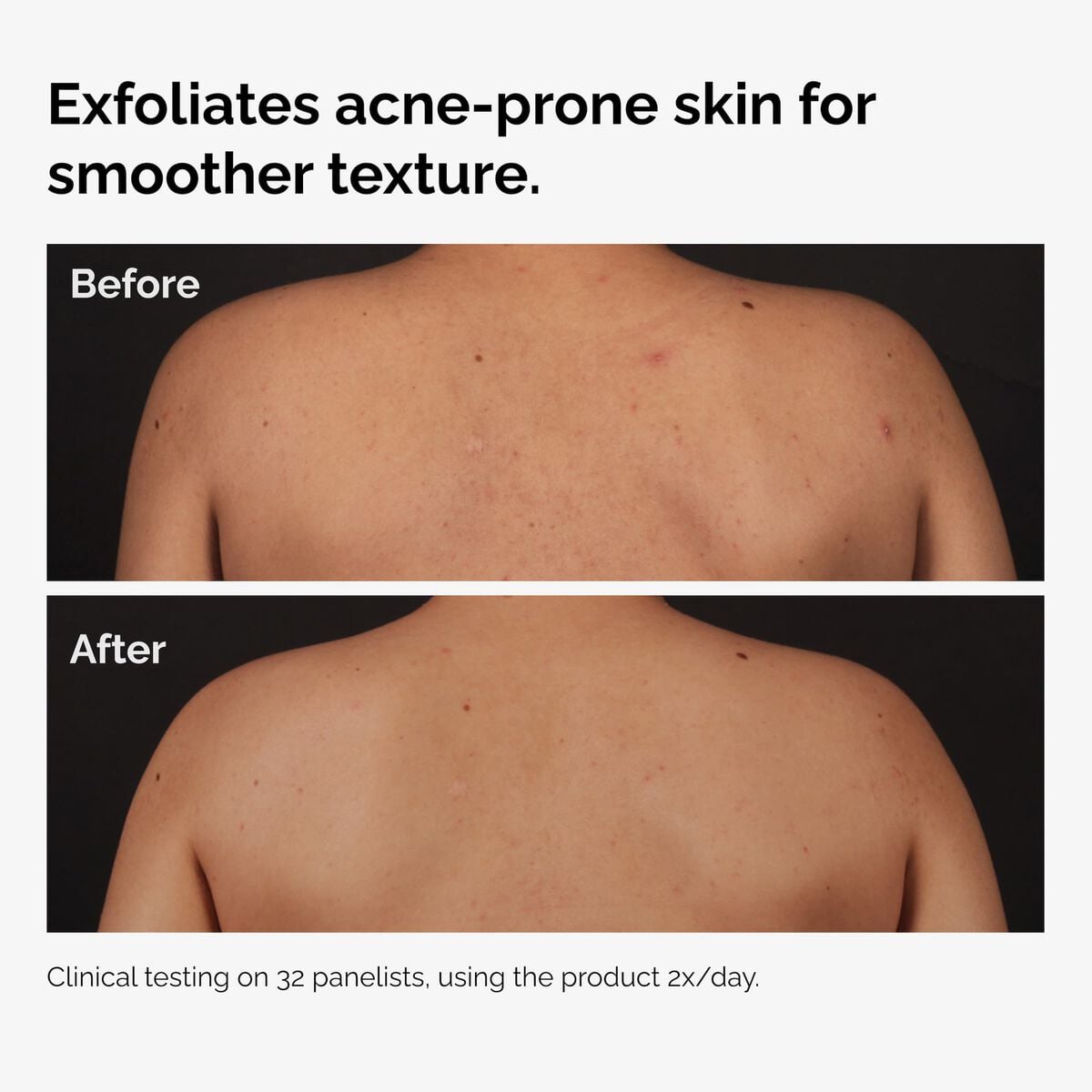 salicylic-acid-0-5-body-serum-m5 ord-salicylic-acid-body-serum-before-after-graphic-NA.jpg
