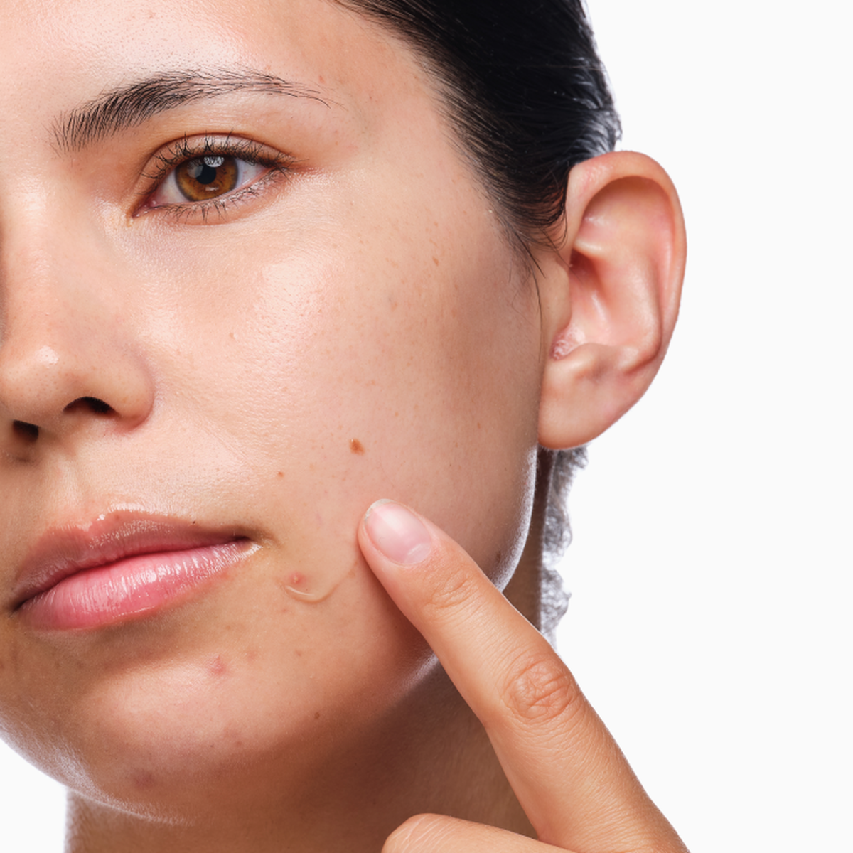 the-acne-set-p3 rdn-the-acne-set-application.png